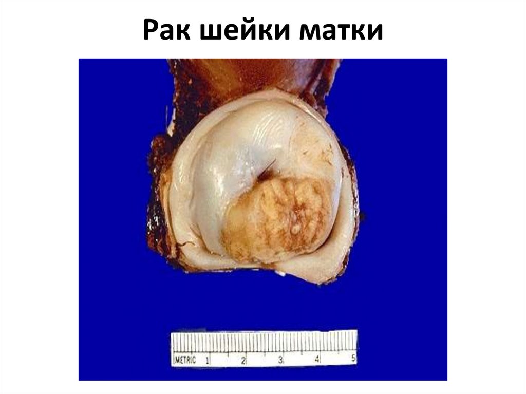 Рак шейки матки