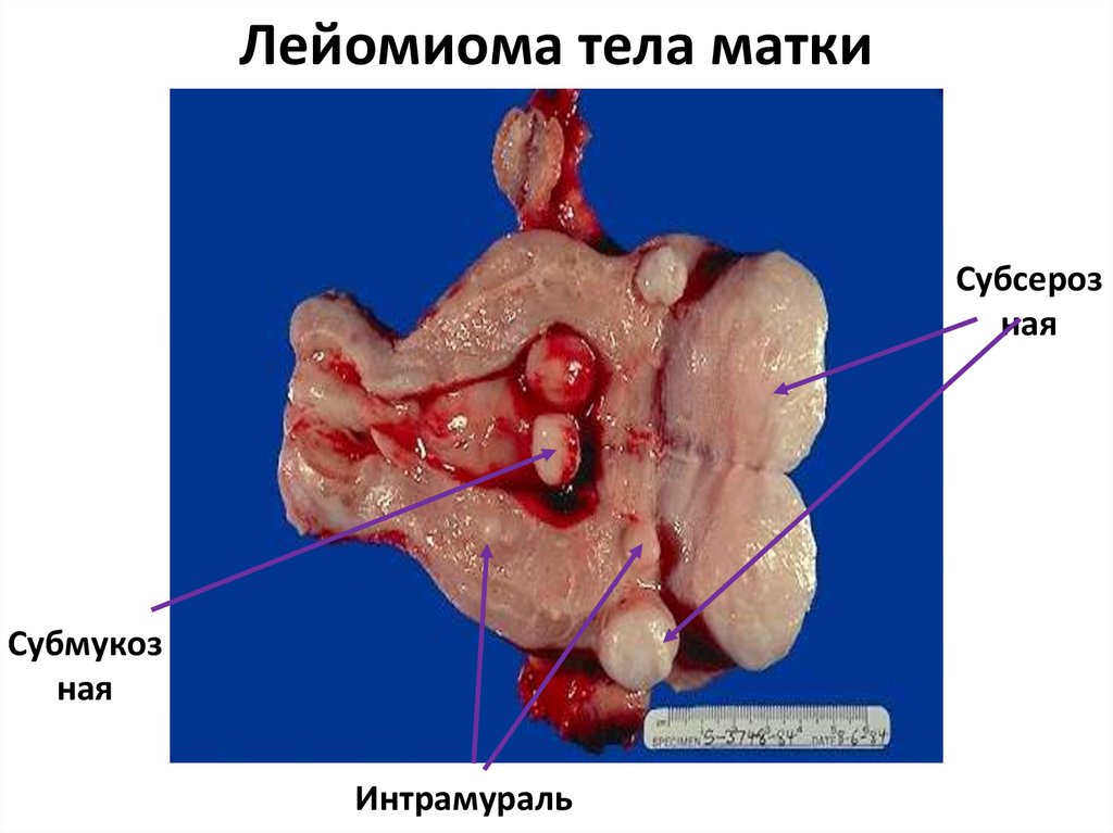 Лейомиома тела матки