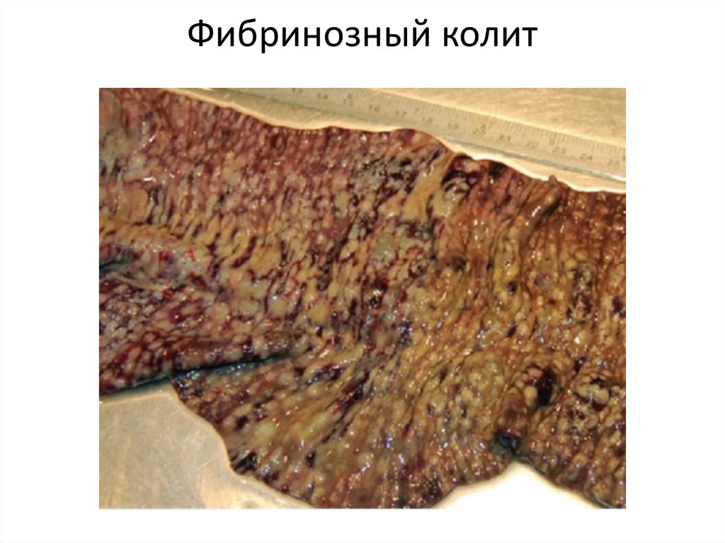 Фибринозный колит