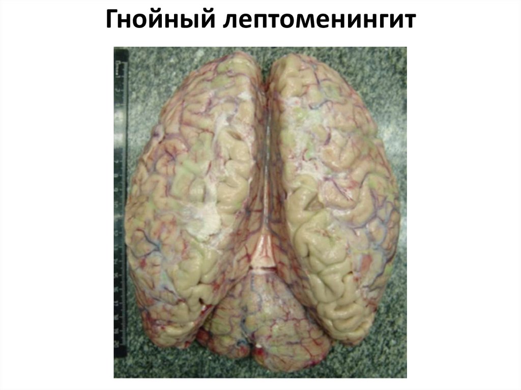 Гнойный лептоменингит