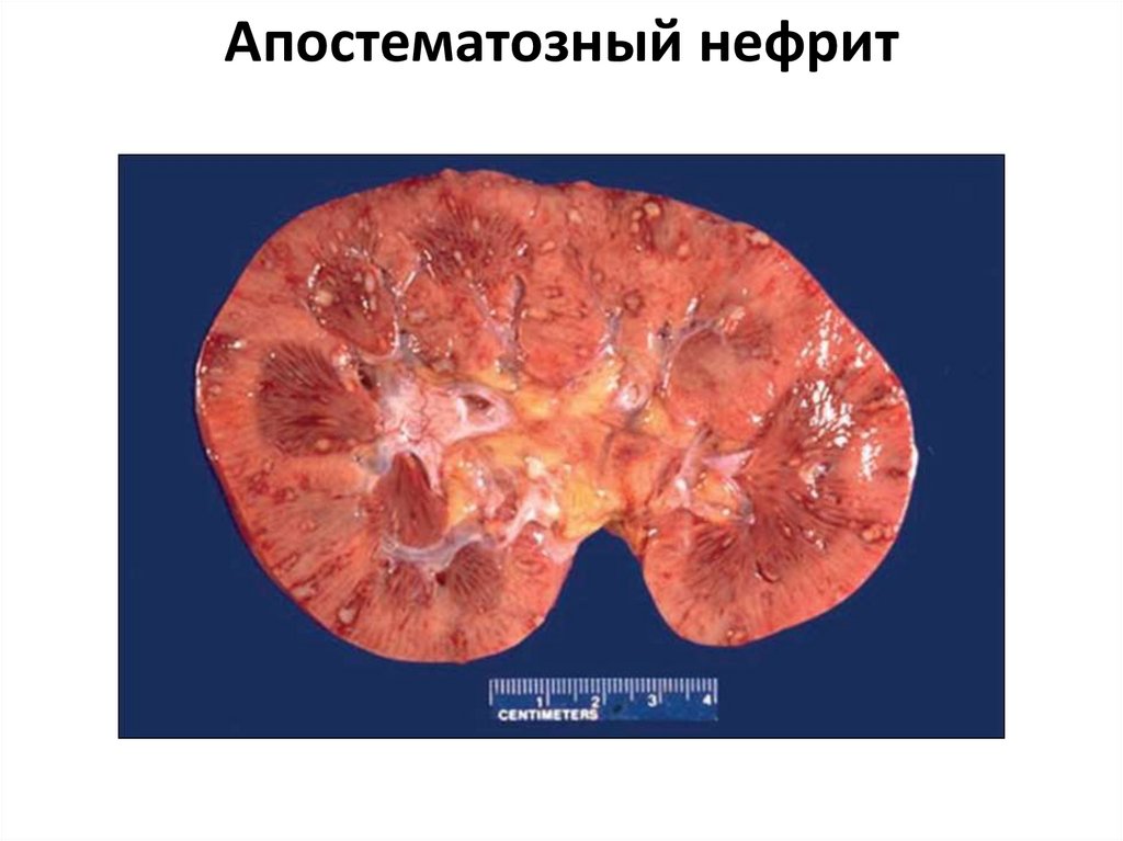 Апостематозный нефрит