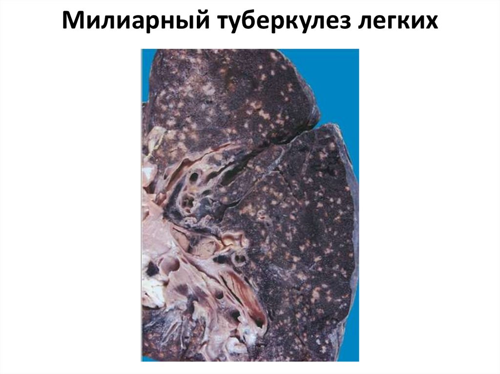 Милиарный туберкулез легких