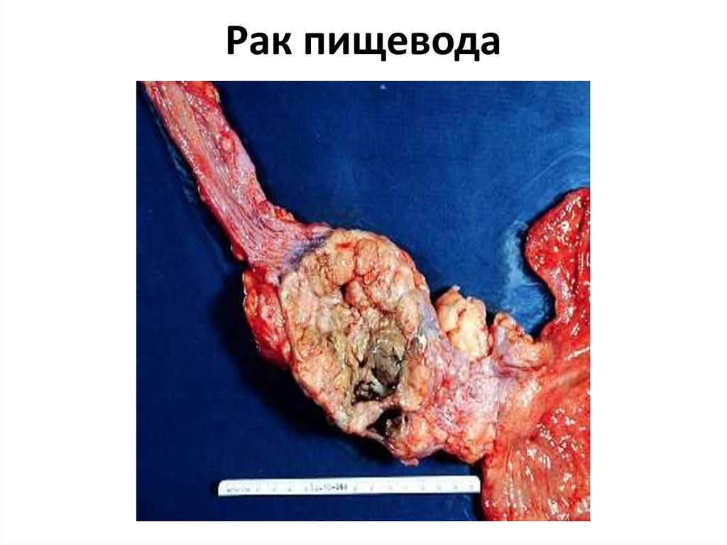 Рак пищевода