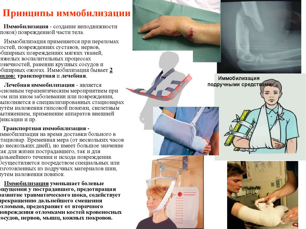 Принципы иммобилизации