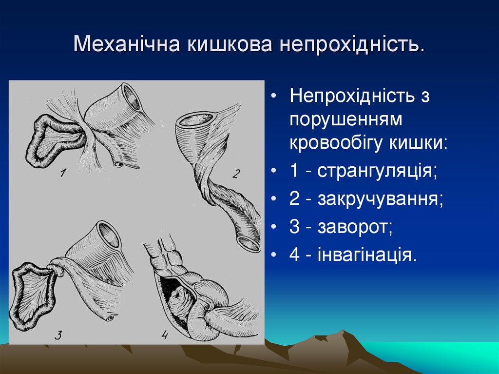 Механічна кишкова непрохідність.