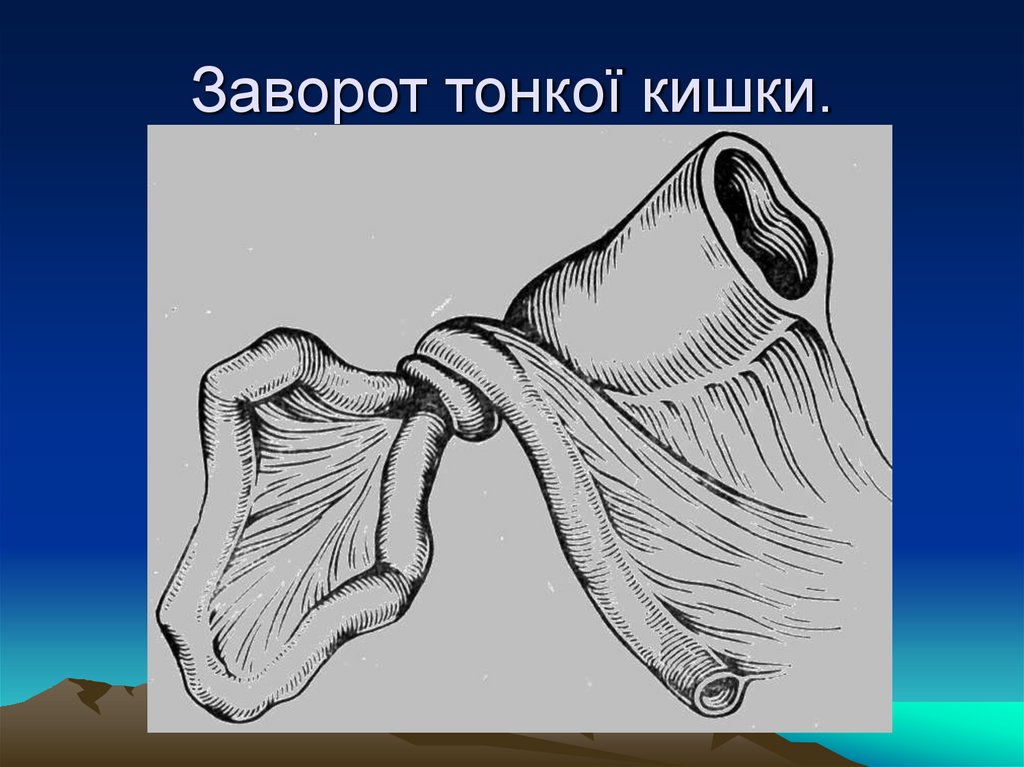 Заворот тонкої кишки.