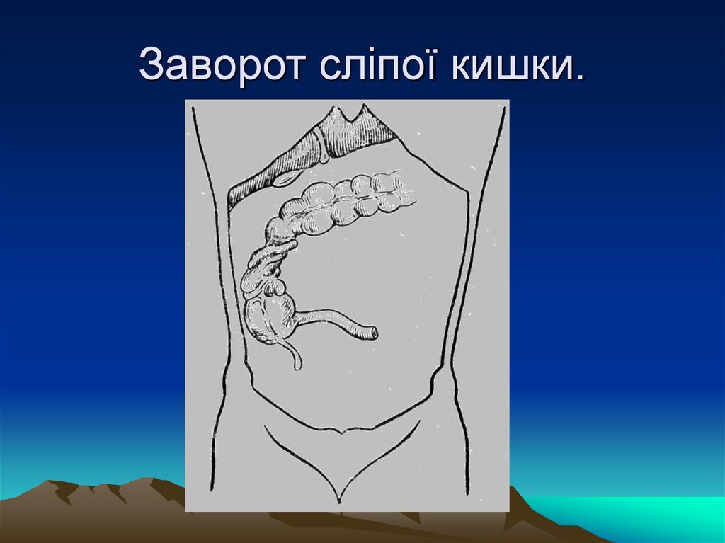 Заворот сліпої кишки.