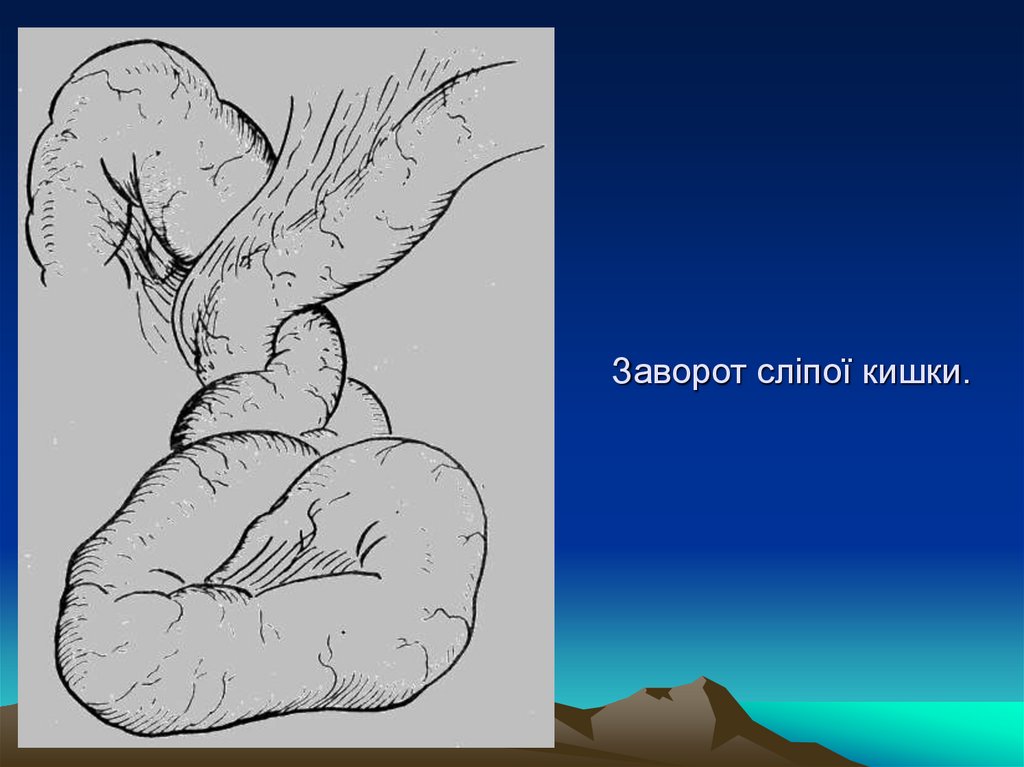 Заворот сліпої кишки.