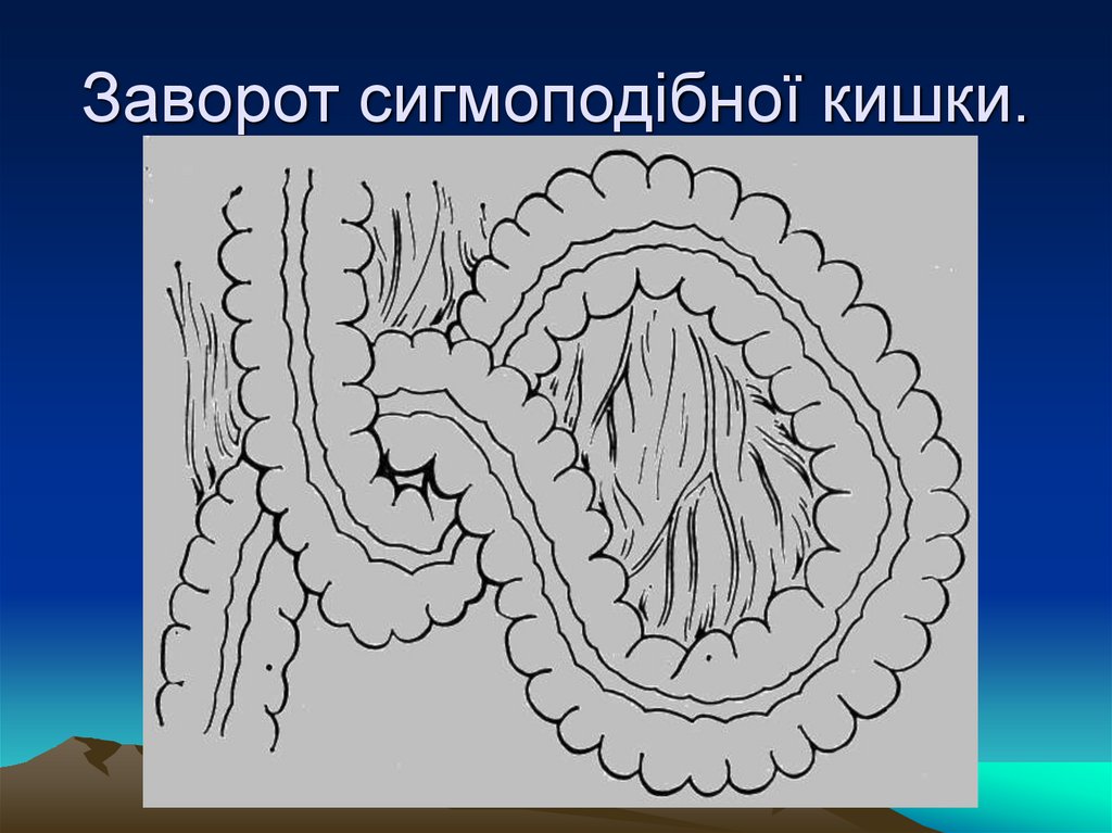 Заворот сигмоподібної кишки.