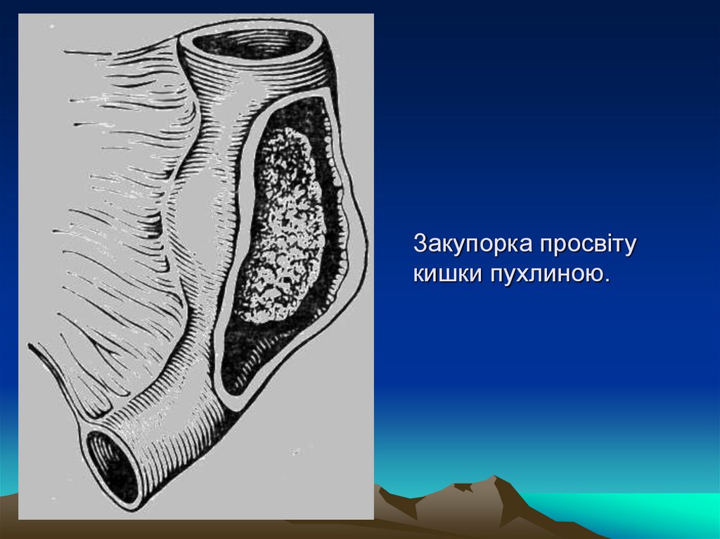 Закупорка просвіту кишки пухлиною.