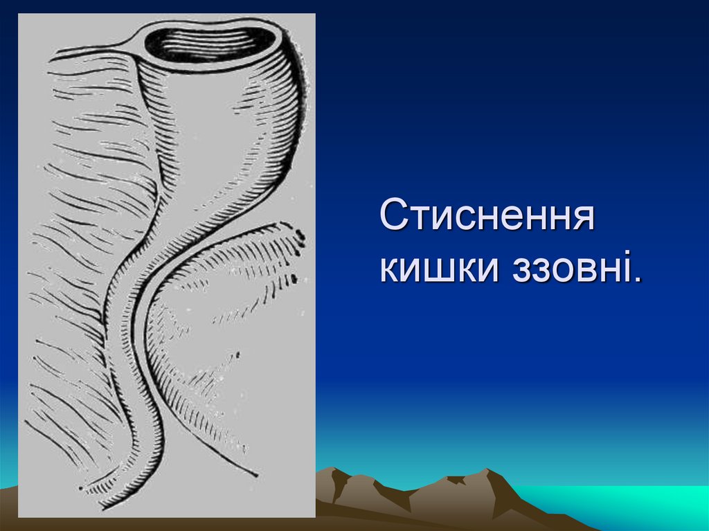 Стиснення кишки ззовні.