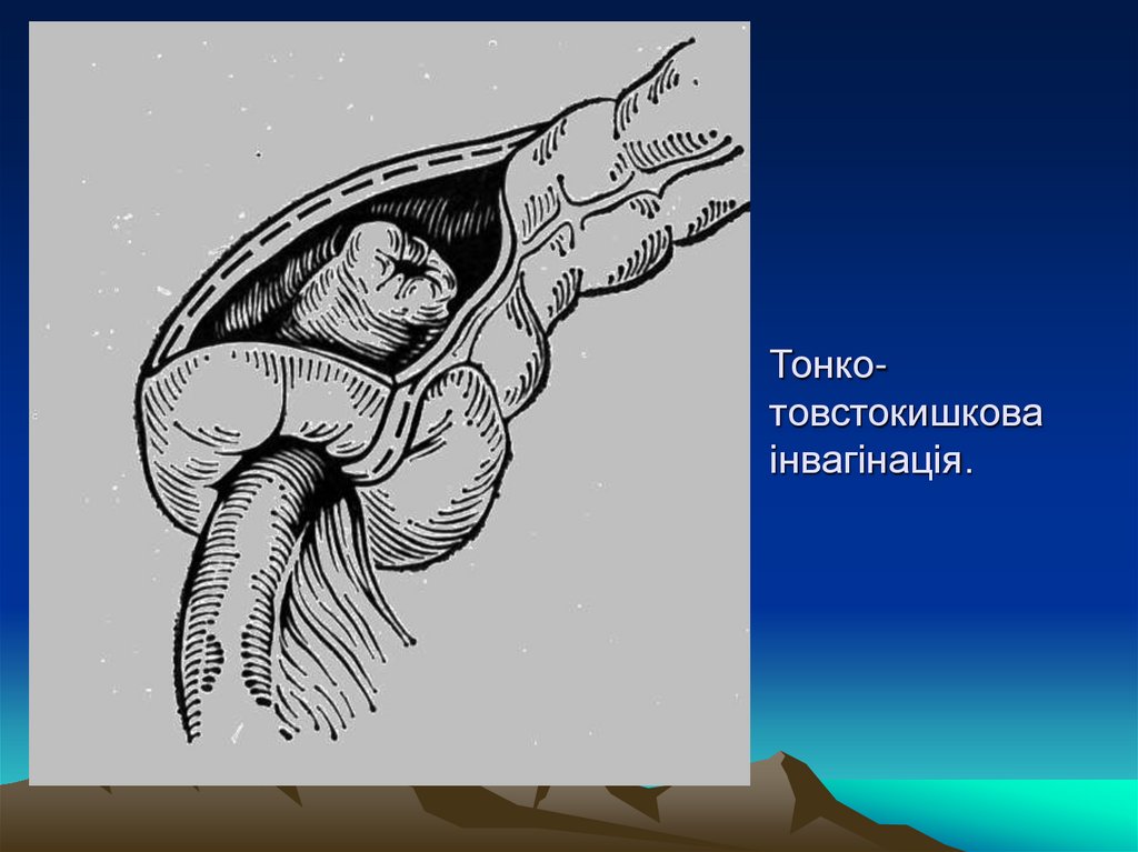 Тонко-товстокишкова інвагінація.