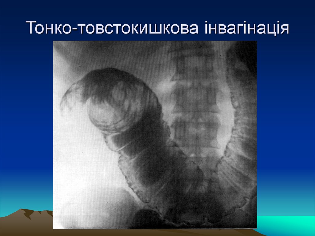 Тонко-товстокишкова інвагінація