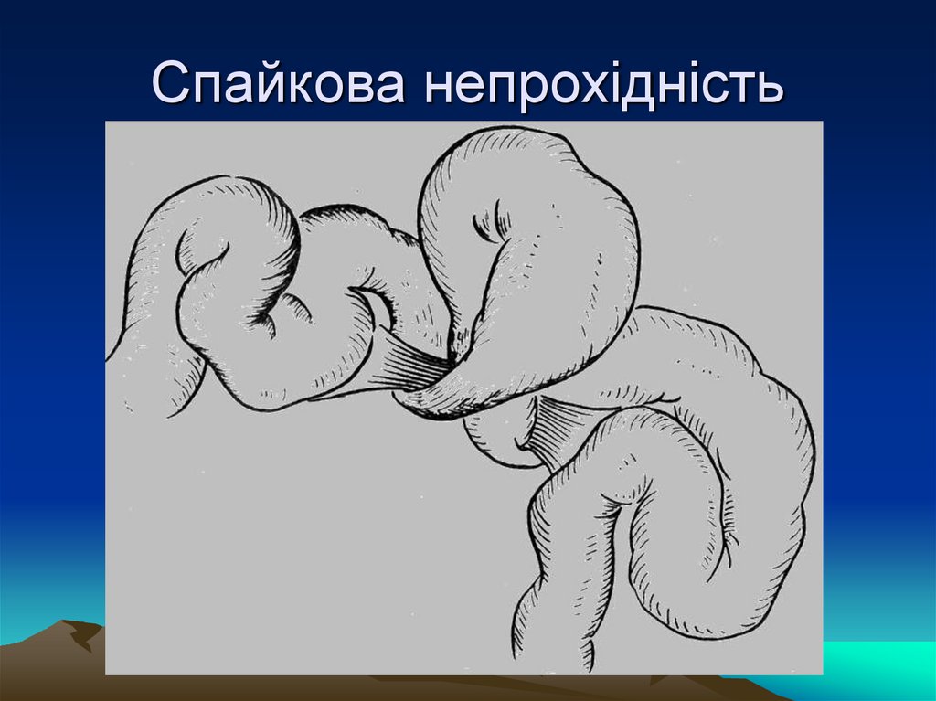 Спайкова непрохідність