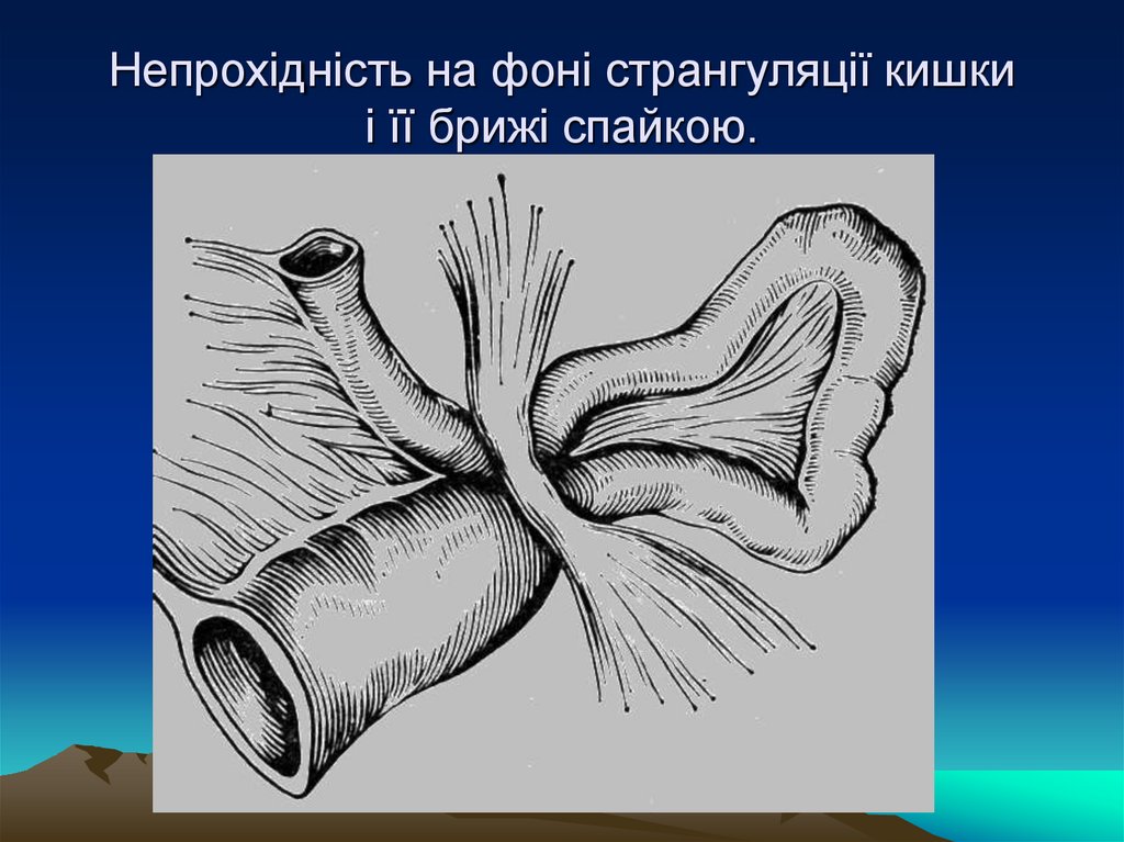 Непрохідність на фоні странгуляції кишки і її брижі спайкою.
