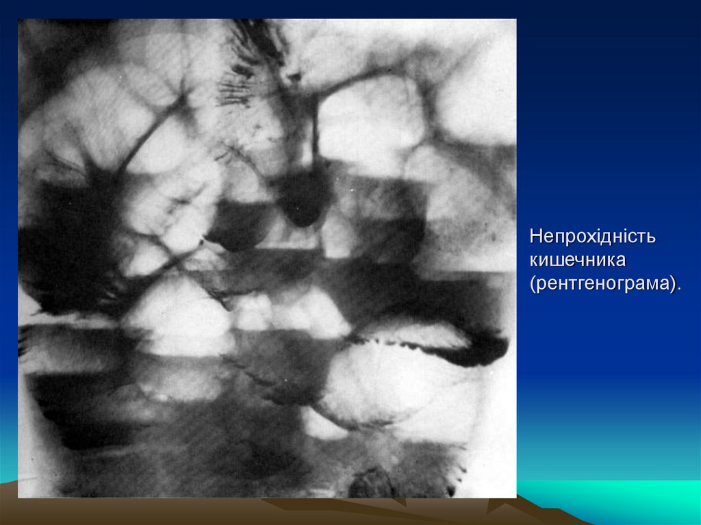 Непрохідність кишечника (рентгенограма).