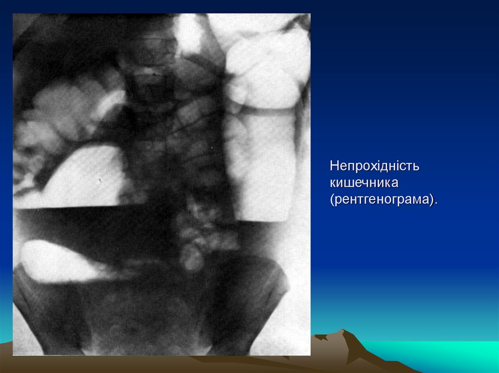 Непрохідність кишечника (рентгенограма).