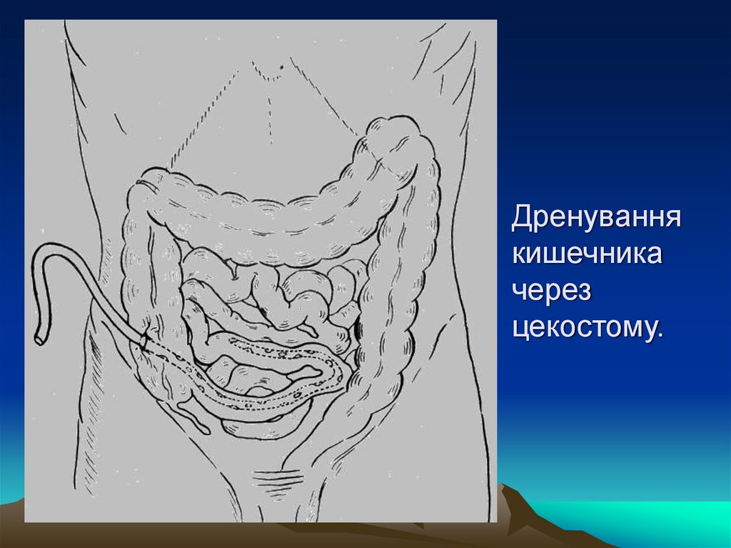 Дренування кишечника через цекостому.