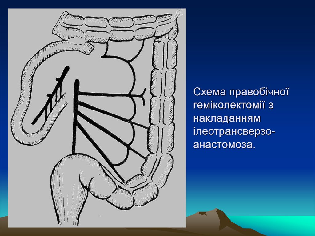 Схема правобічної геміколектомії з накладанням ілеотрансверзо-анастомоза.