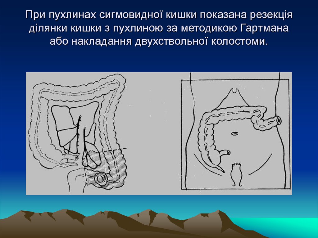 При пухлинах сигмовидної кишки показана резекція ділянки кишки з пухлиною за методикою Гартмана або накладання двухствольної