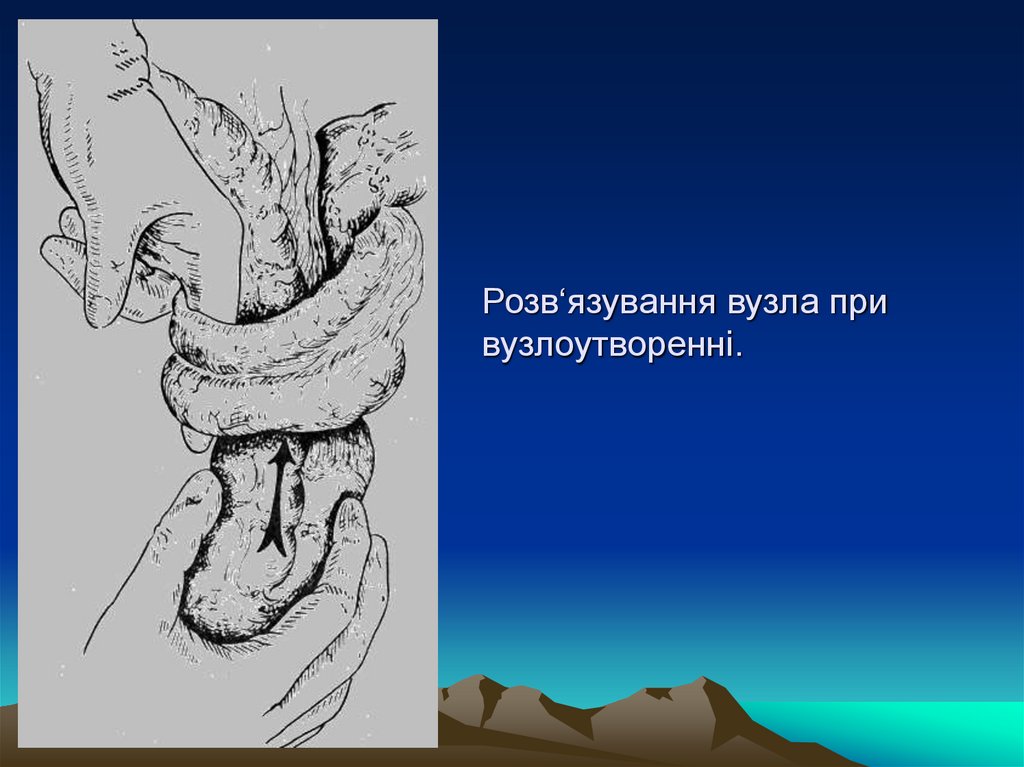 Розв‘язування вузла при вузлоутворенні.