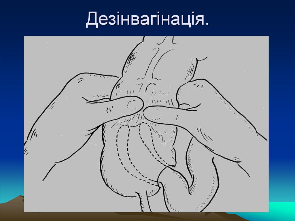 Дезінвагінація.