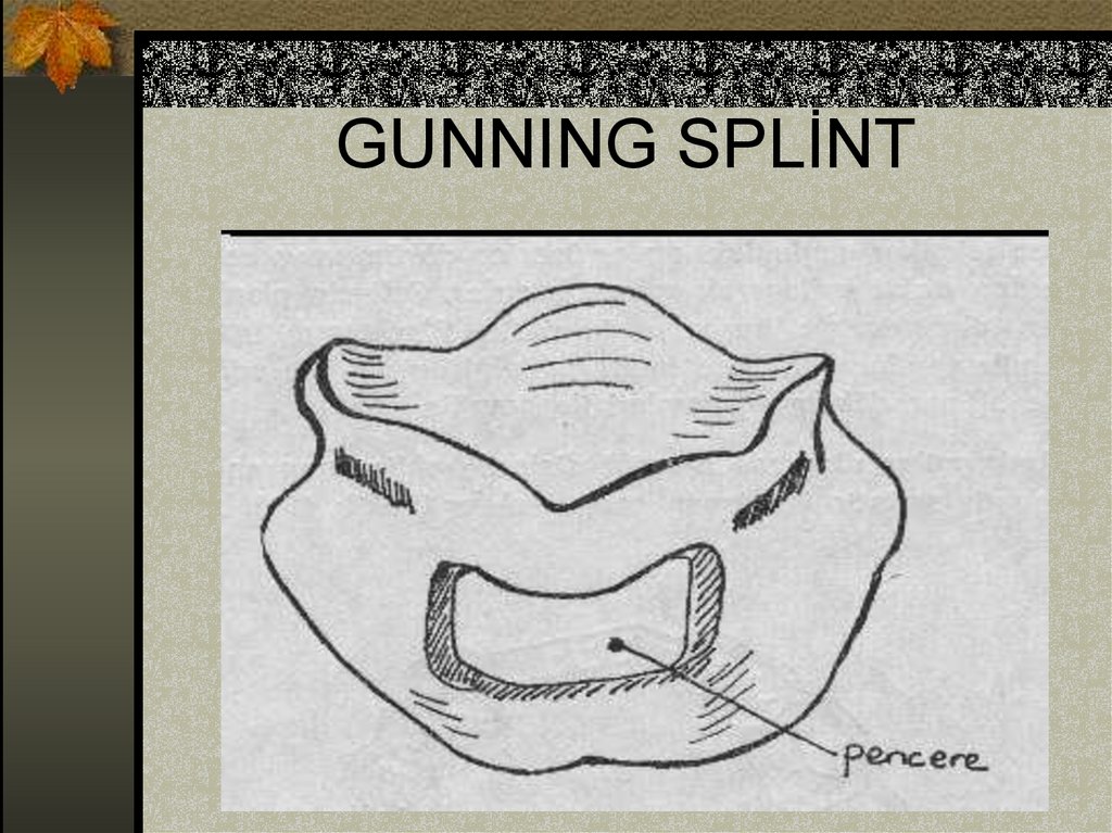 GUNNING SPLİNT
