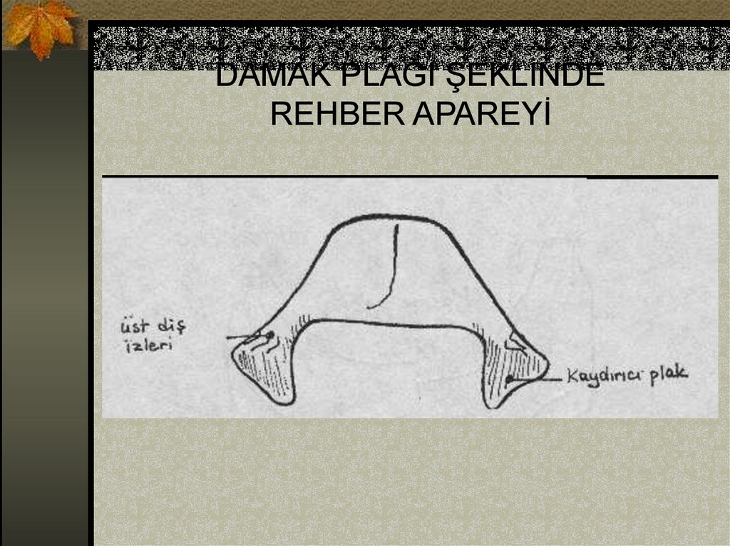 DAMAK PLAĞI ŞEKLİNDE REHBER APAREYİ