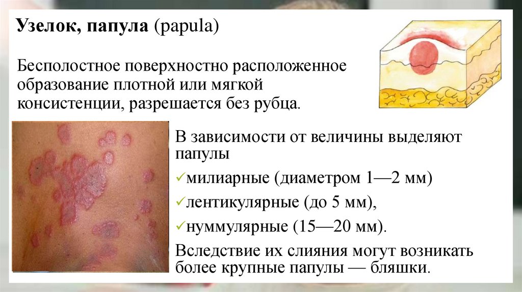 Узелок, папула (papula)