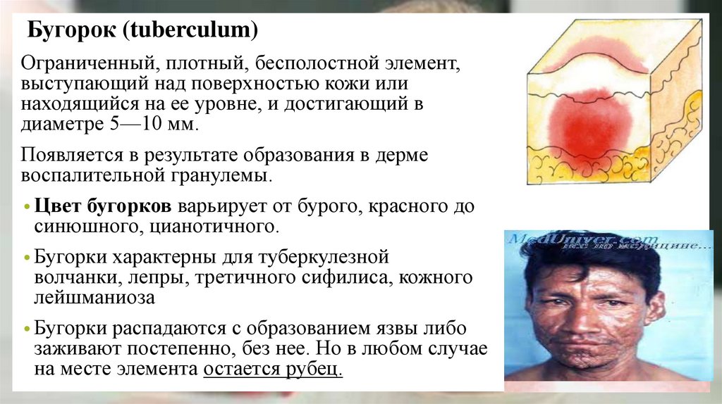 Бугорок (tuberculum)