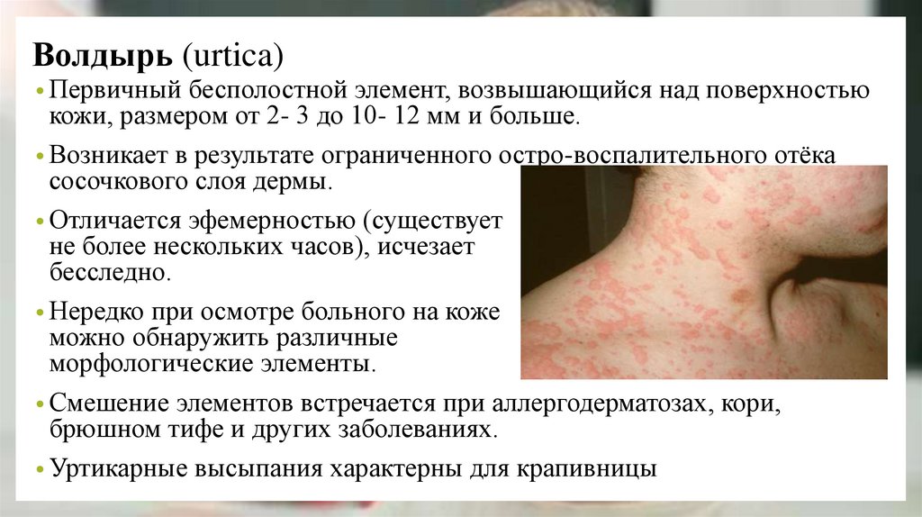 Волдырь (urtica)