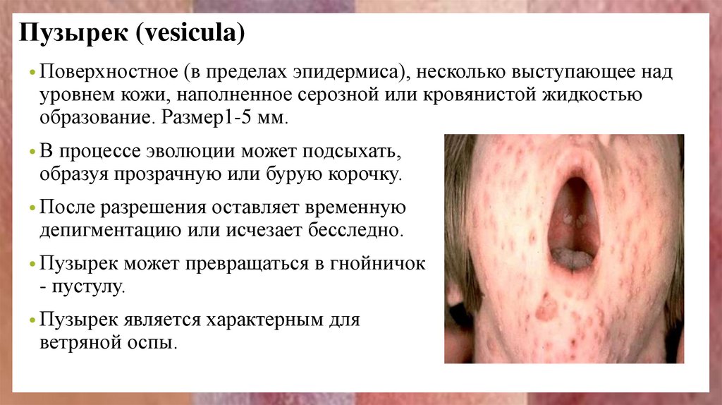 Пузырек (vesicula)