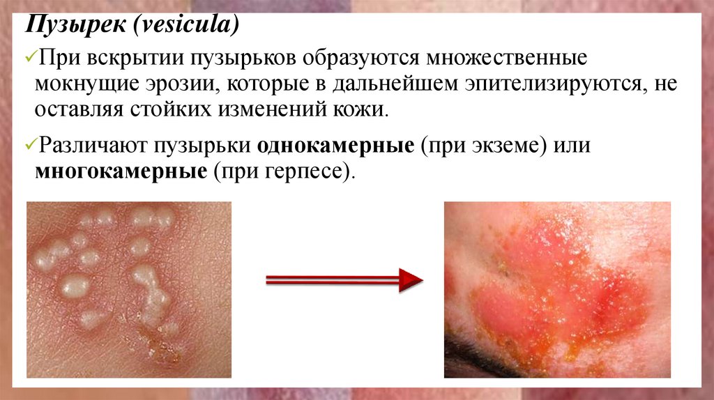 Пузырек (vesicula)