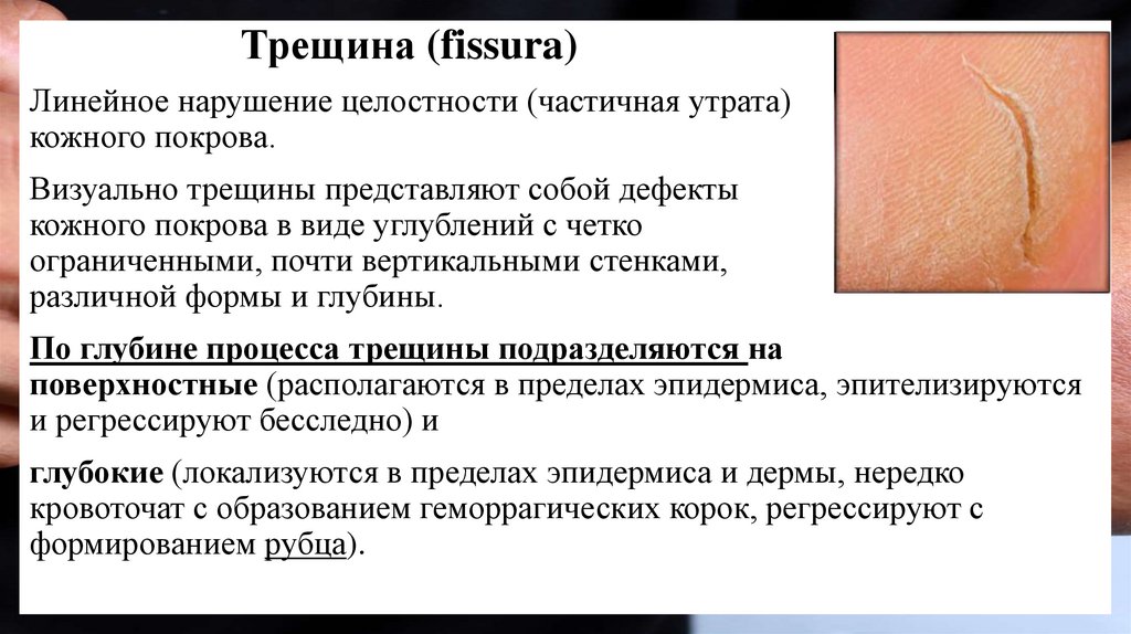 Трещина (fissura) 