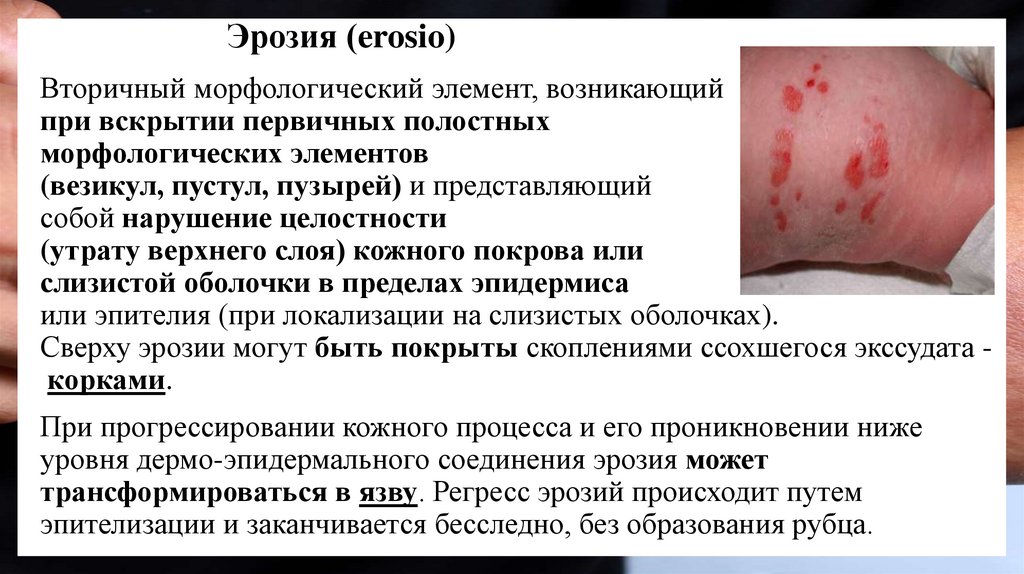 Эрозия (erosio)