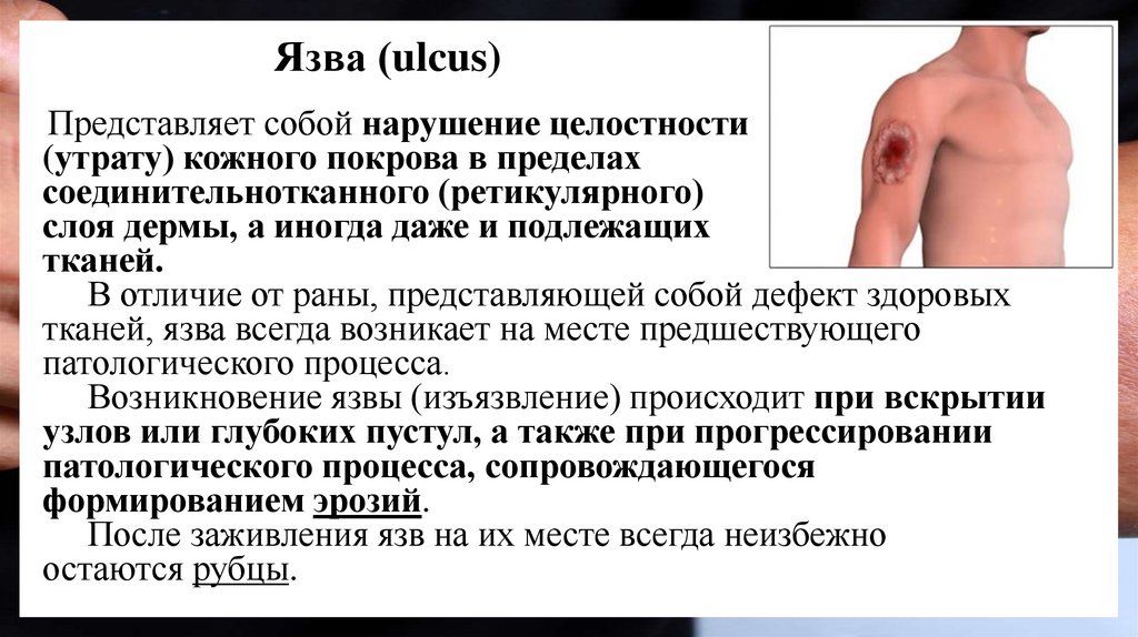 Язва (ulcus)