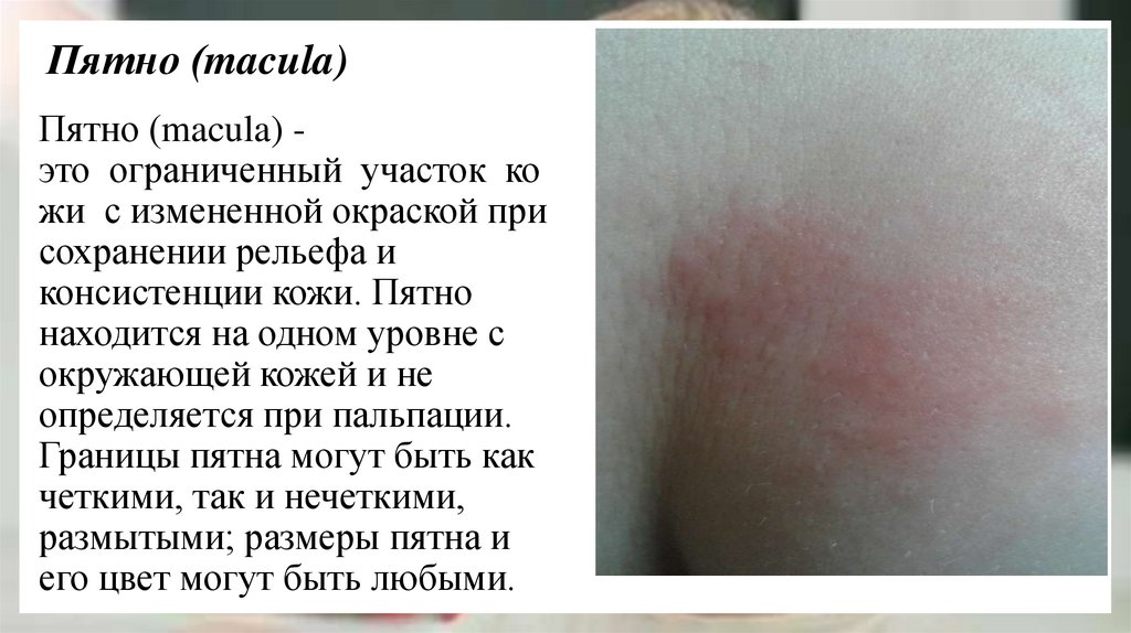 Пятно (macula)