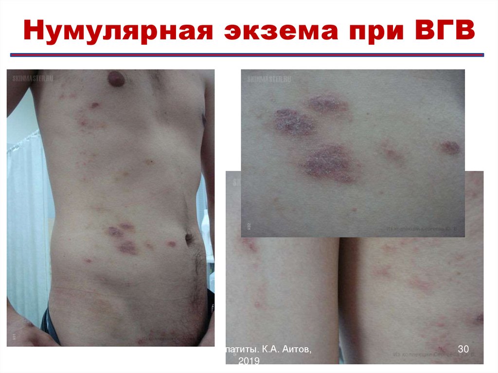 Клинические особенности ВГВ: