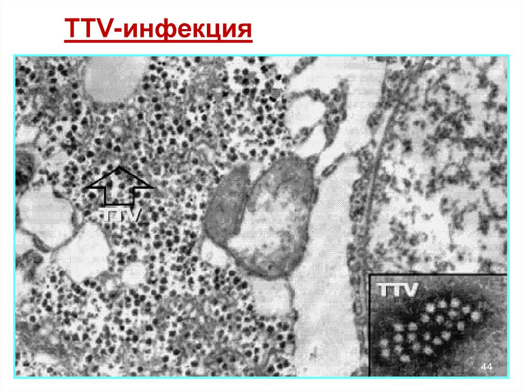 ТТV-инфекция (Torque teno virusis)
