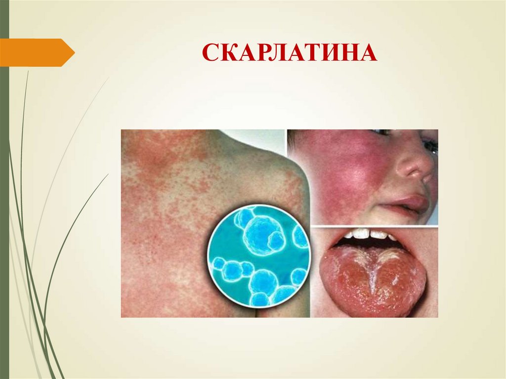 СКАРЛАТИНА