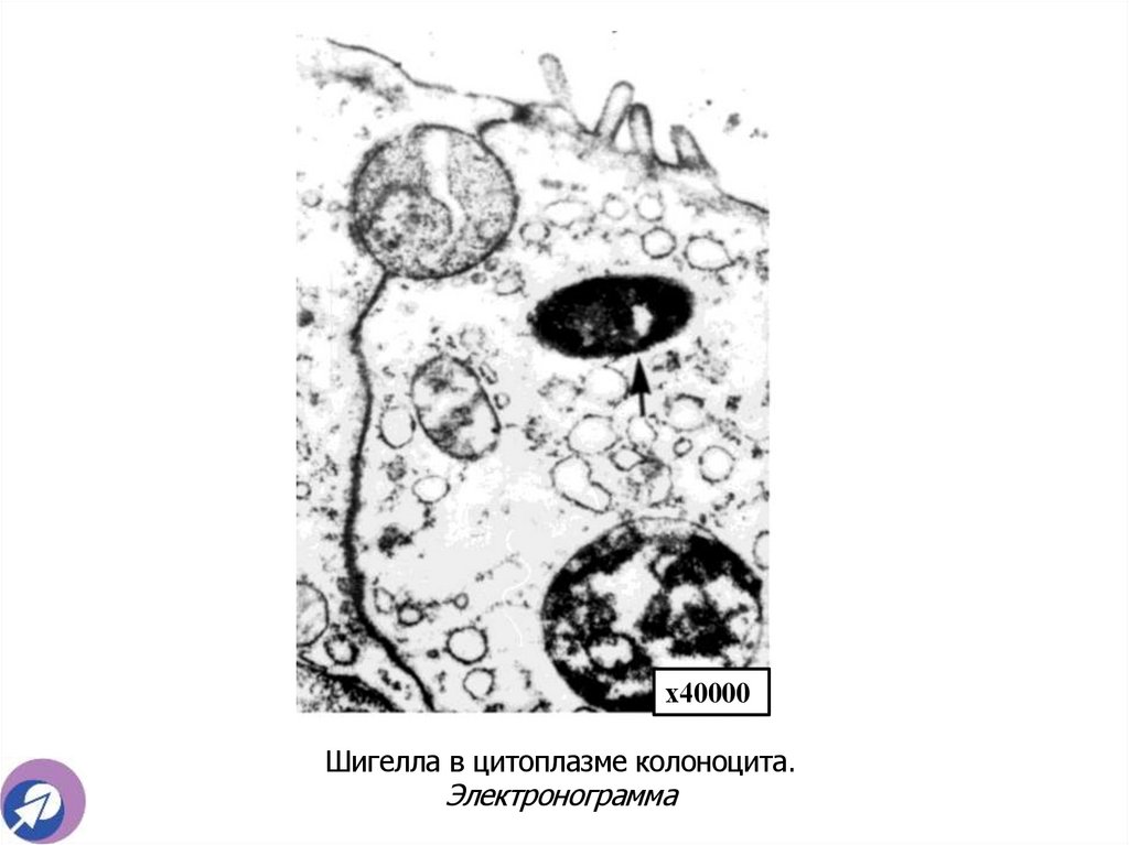 Шигелла в цитоплазме колоноцита. Электронограмма