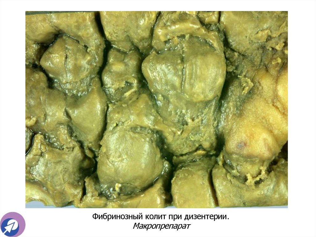 Фибринозный колит при дизентерии. Макропрепарат
