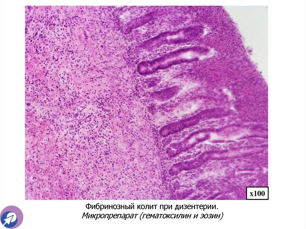 Фибринозный колит при дизентерии. Микропрепарат (гематоксилин и эозин)