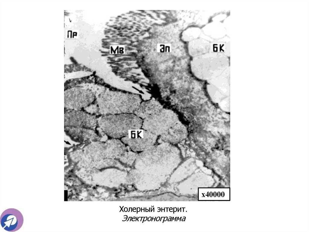 Холерный энтерит. Электронограмма
