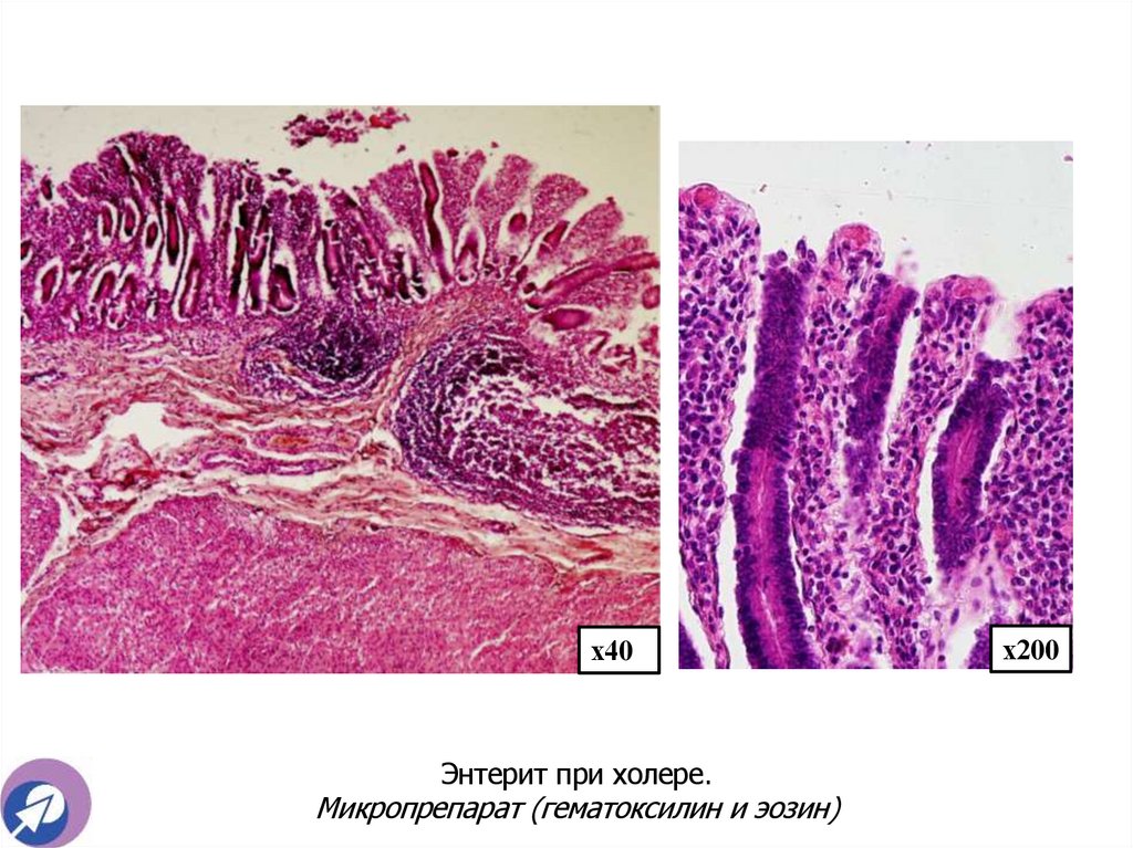 Энтерит при холере. Микропрепарат (гематоксилин и эозин)