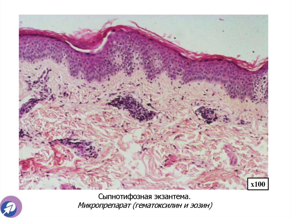 Сыпнотифозная экзантема. Микропрепарат (гематоксилин и эозин)
