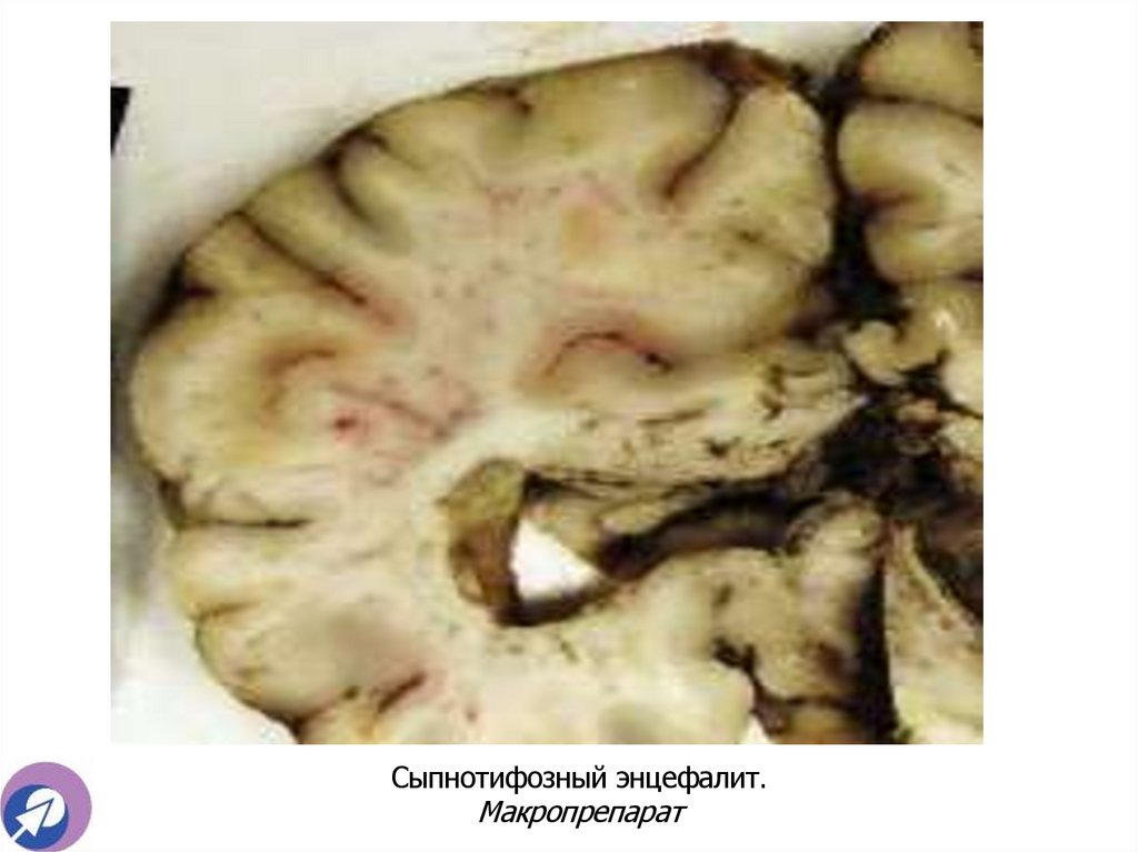 Сыпнотифозный энцефалит. Макропрепарат