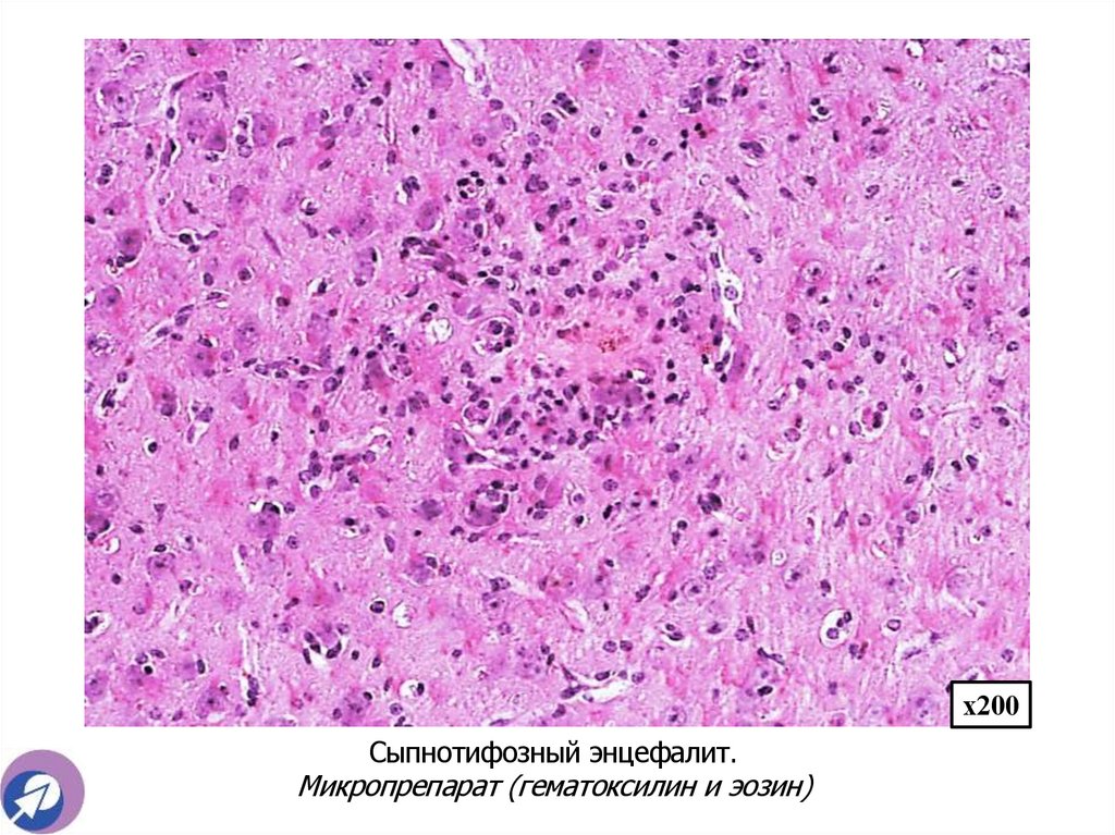 Сыпнотифозный энцефалит. Микропрепарат (гематоксилин и эозин)