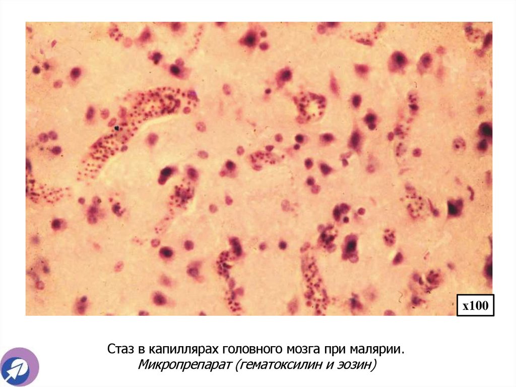 Стаз в капиллярах головного мозга при малярии. Микропрепарат (гематоксилин и эозин)
