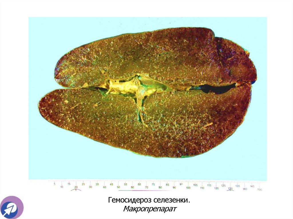 Гемосидероз селезенки. Макропрепарат